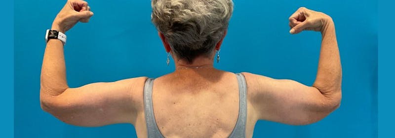 Brachioplasty (Arm Lifts) Before & After Gallery - Patient 335379 - Image 7