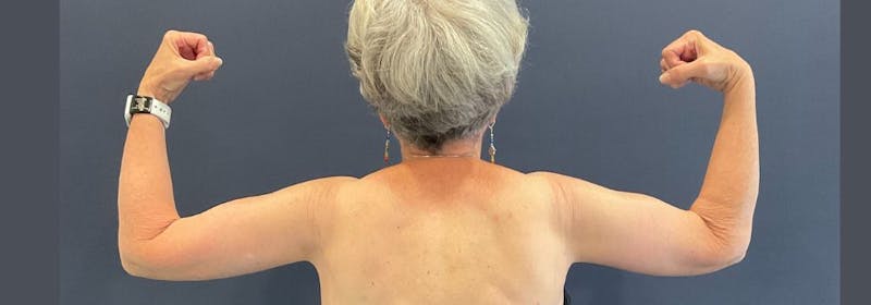 Brachioplasty (Arm Lifts) Before & After Gallery - Patient 335379 - Image 8