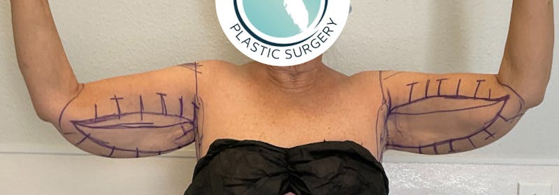 Brachioplasty (Arm Lifts) Before & After Gallery - Patient 449121 - Image 1