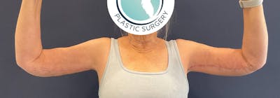 Brachioplasty (Arm Lifts) Before & After Gallery - Patient 449121 - Image 2
