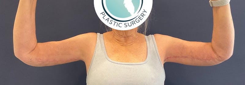 Brachioplasty (Arm Lifts) Before & After Gallery - Patient 449121 - Image 2