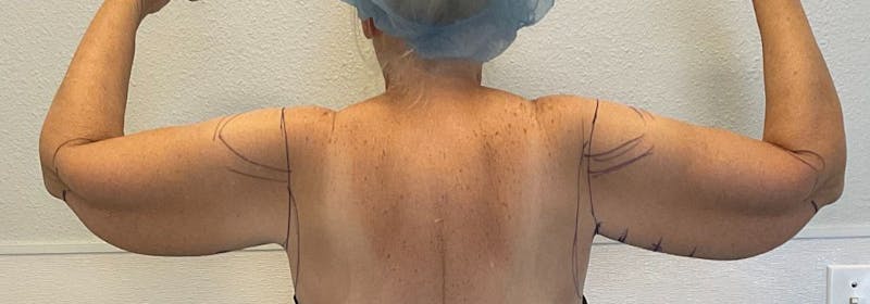 Brachioplasty (Arm Lifts) Before & After Gallery - Patient 449121 - Image 3