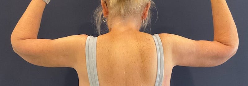 Brachioplasty (Arm Lifts) Before & After Gallery - Patient 449121 - Image 4