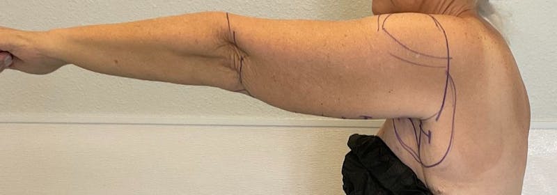 Brachioplasty (Arm Lifts) Before & After Gallery - Patient 449121 - Image 5