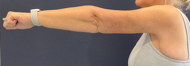 Brachioplasty (Arm Lifts) Before & After Gallery - Patient 449121 - Image 6