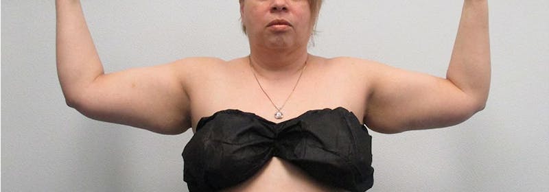 Brachioplasty (Arm Lifts) Before & After Gallery - Patient 182685 - Image 1