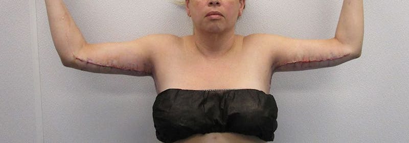 Brachioplasty (Arm Lifts) Before & After Gallery - Patient 182685 - Image 2