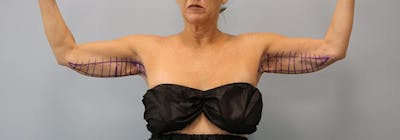 Brachioplasty (Arm Lifts) Before & After Gallery - Patient 271812 - Image 1