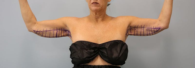 Brachioplasty (Arm Lifts) Before & After Gallery - Patient 271812 - Image 1