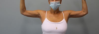 Brachioplasty (Arm Lifts) Before & After Gallery - Patient 271812 - Image 2