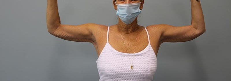 Brachioplasty (Arm Lifts) Before & After Gallery - Patient 271812 - Image 2