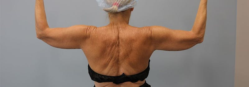Brachioplasty (Arm Lifts) Before & After Gallery - Patient 271812 - Image 3