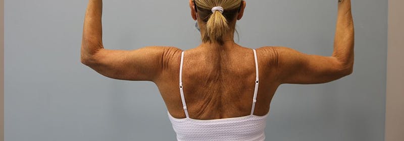 Brachioplasty (Arm Lifts) Before & After Gallery - Patient 271812 - Image 4