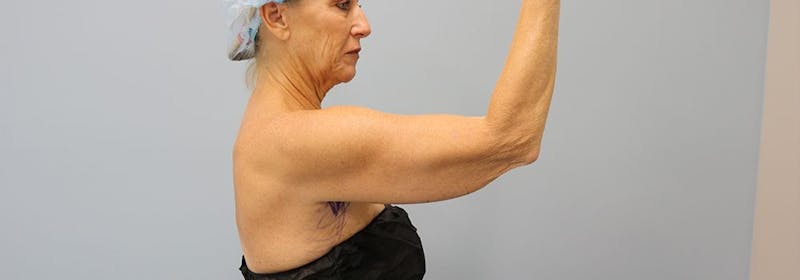 Brachioplasty (Arm Lifts) Before & After Gallery - Patient 271812 - Image 5