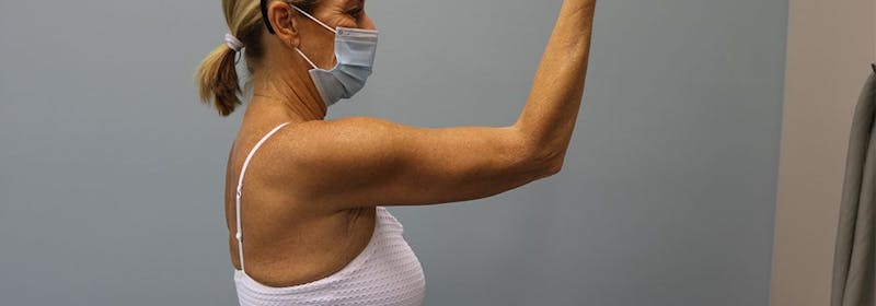 Brachioplasty (Arm Lifts) Before & After Gallery - Patient 271812 - Image 6