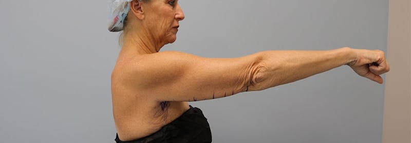 Brachioplasty (Arm Lifts) Before & After Gallery - Patient 271812 - Image 7