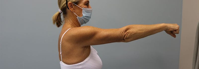 Brachioplasty (Arm Lifts) Before & After Gallery - Patient 271812 - Image 8