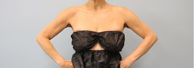 Brachioplasty (Arm Lifts) Before & After Gallery - Patient 271812 - Image 9