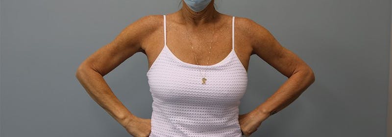 Brachioplasty (Arm Lifts) Before & After Gallery - Patient 271812 - Image 10