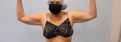 Brachioplasty (Arm Lifts) Before & After Gallery - Patient 270315 - Image 1