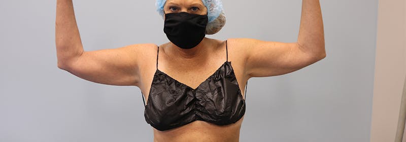 Brachioplasty (Arm Lifts) Before & After Gallery - Patient 270315 - Image 1