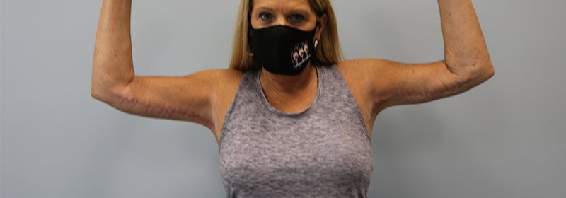 Brachioplasty (Arm Lifts) Before & After Gallery - Patient 270315 - Image 2