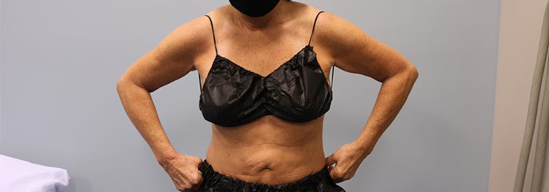 Brachioplasty (Arm Lifts) Before & After Gallery - Patient 270315 - Image 3