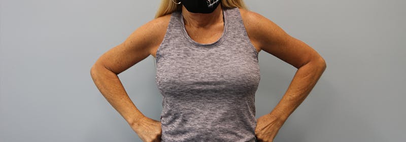 Brachioplasty (Arm Lifts) Before & After Gallery - Patient 270315 - Image 4