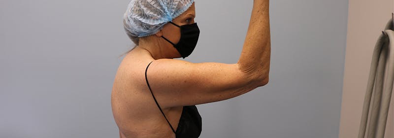 Brachioplasty (Arm Lifts) Before & After Gallery - Patient 270315 - Image 5