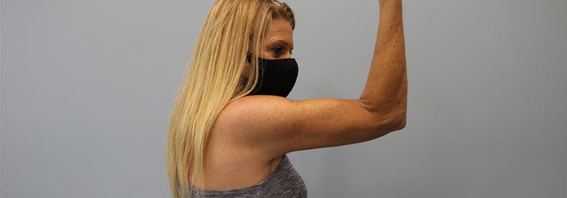 Brachioplasty (Arm Lifts) Before & After Gallery - Patient 270315 - Image 6