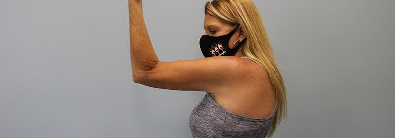 Brachioplasty (Arm Lifts) Before & After Gallery - Patient 270315 - Image 8