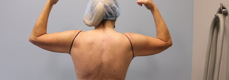 Brachioplasty (Arm Lifts) Before & After Gallery - Patient 270315 - Image 9
