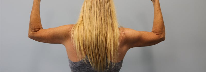 Brachioplasty (Arm Lifts) Before & After Gallery - Patient 270315 - Image 10