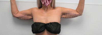 Brachioplasty (Arm Lifts) Before & After Gallery - Patient 182606 - Image 1