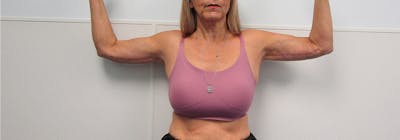 Brachioplasty (Arm Lifts) Before & After Gallery - Patient 182606 - Image 2