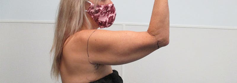 Brachioplasty (Arm Lifts) Before & After Gallery - Patient 182606 - Image 3