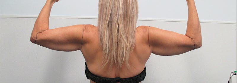 Brachioplasty (Arm Lifts) Before & After Gallery - Patient 182606 - Image 5