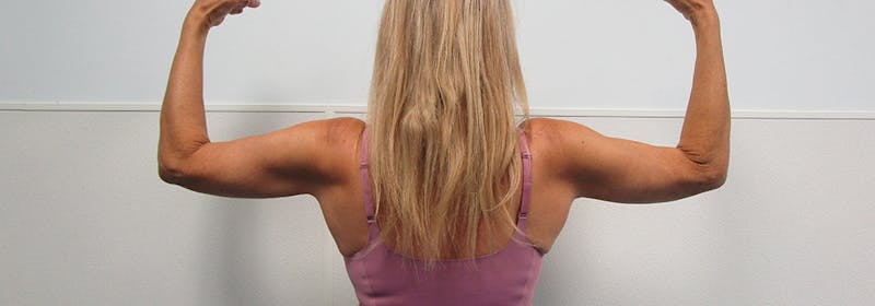 Brachioplasty (Arm Lifts) Before & After Gallery - Patient 182606 - Image 6