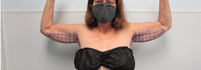 Brachioplasty (Arm Lifts) Before & After Gallery - Patient 182343 - Image 1
