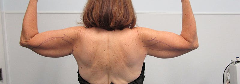 Brachioplasty (Arm Lifts) Before & After Gallery - Patient 182343 - Image 3