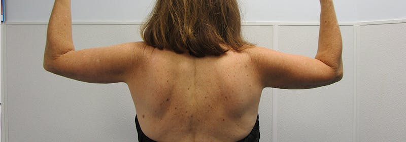 Brachioplasty (Arm Lifts) Before & After Gallery - Patient 182343 - Image 4