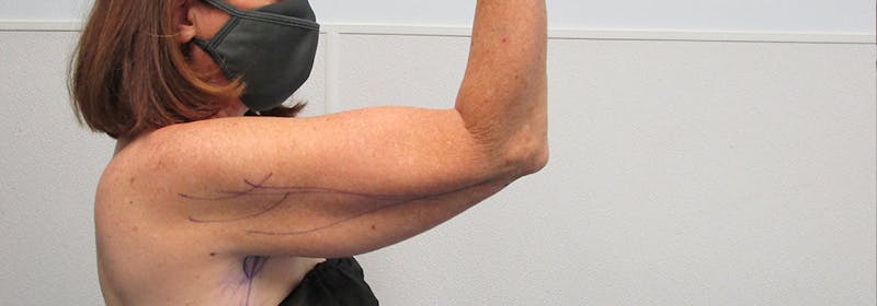 Brachioplasty (Arm Lifts) Before & After Gallery - Patient 182343 - Image 5