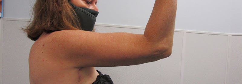 Brachioplasty (Arm Lifts) Before & After Gallery - Patient 182343 - Image 6