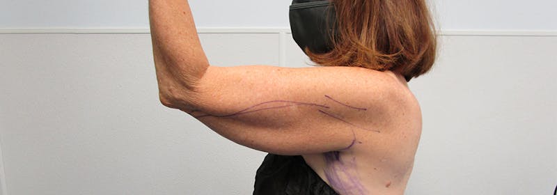 Brachioplasty (Arm Lifts) Before & After Gallery - Patient 182343 - Image 7