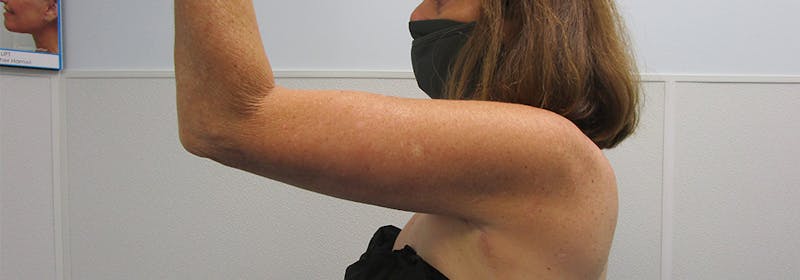 Brachioplasty (Arm Lifts) Before & After Gallery - Patient 182343 - Image 8