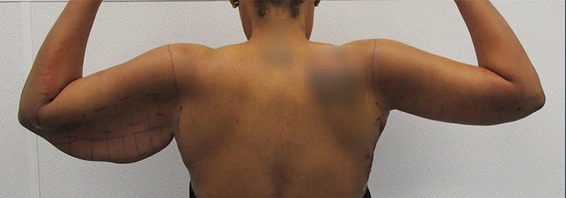 Brachioplasty (Arm Lifts) Before & After Gallery - Patient 417926 - Image 1