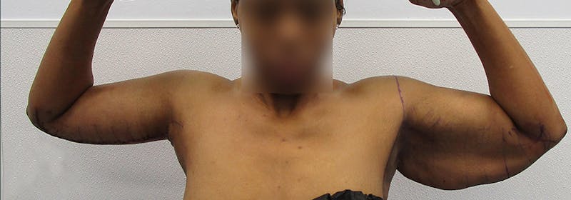 Brachioplasty (Arm Lifts) Before & After Gallery - Patient 417926 - Image 2