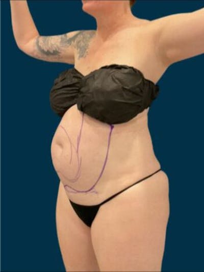 Liposuction Before & After Gallery - Patient 370256 - Image 1