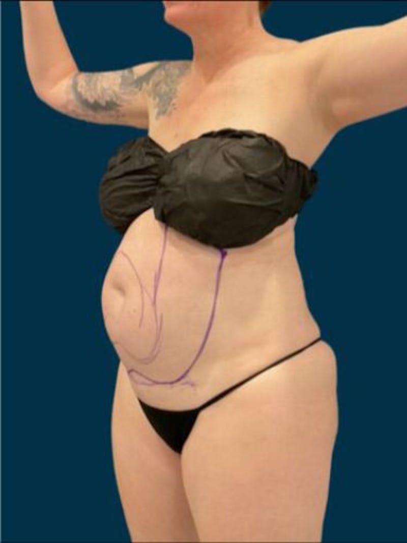 Liposuction Before & After Gallery - Patient 370256 - Image 1