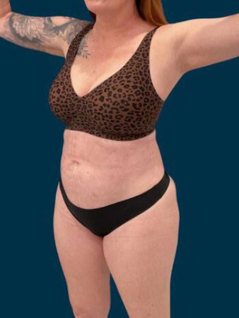 Liposuction Before & After Gallery - Patient 370256 - Image 2